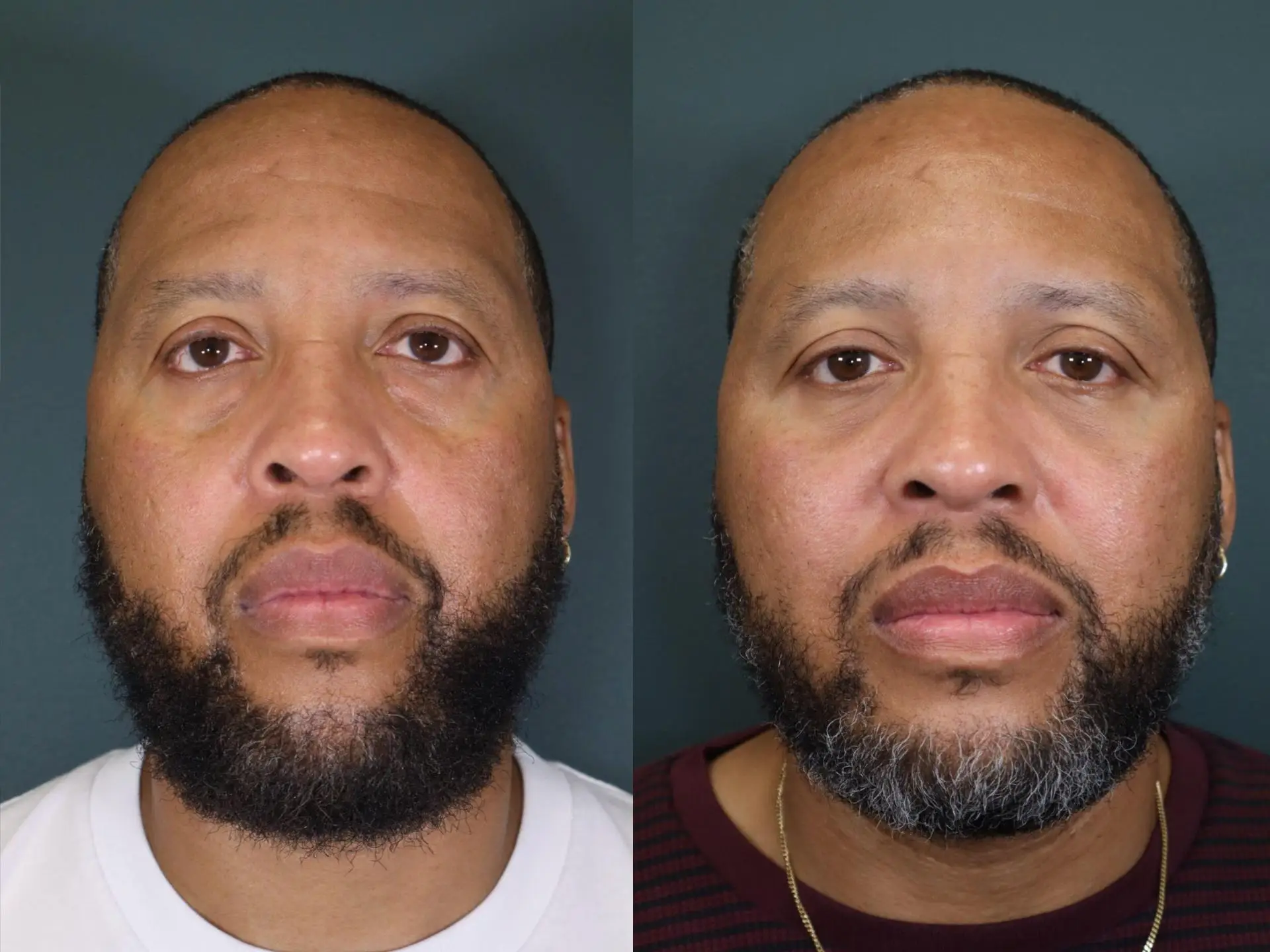 A man before and after having a blepharoplasty.