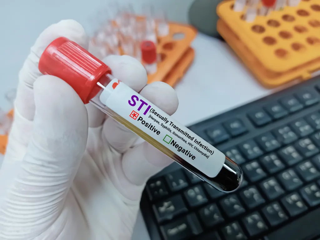 Hand in white glove holding a blood sample tube with a label indicating a positive STI (Sexually Transmitted Infection) test result.