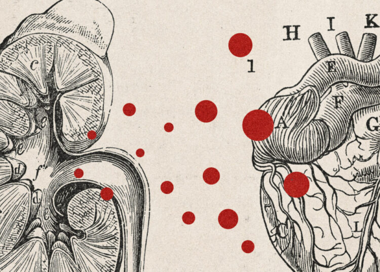 Scientists finally may know why kidney patients die of heart disease