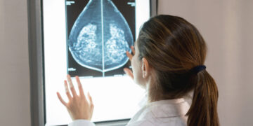 The case for more personalized breast cancer screening