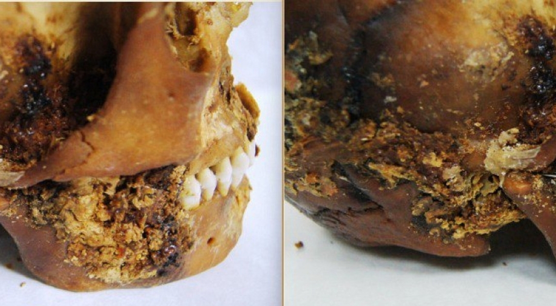 Mummified Skull Reveals Iron Age Woman Survived Brutal Jaw Surgery
