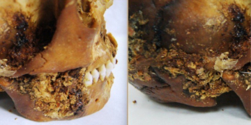 Mummified Skull Reveals Iron Age Woman Survived Brutal Jaw Surgery