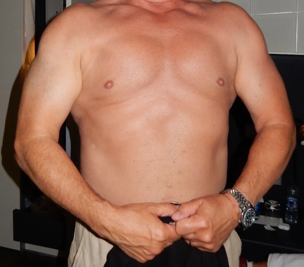 Man's chest and arms after liposuction.