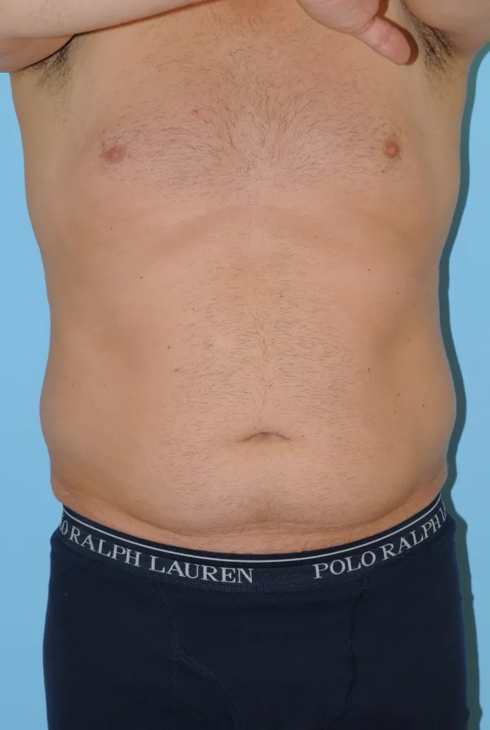 Before photo of Ross Catanzarite's torso, showing excess fat on the abdomen and sides.