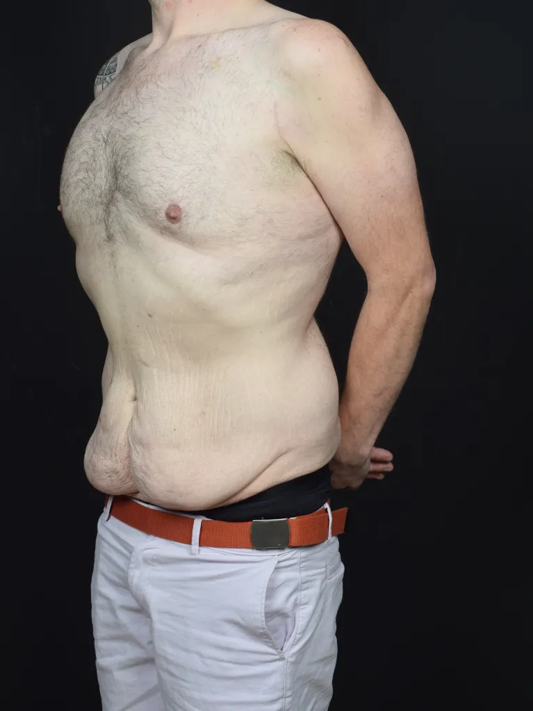 Side view of Robert Tice's torso before lower stomach skin surgery, showing loose skin and stretch marks.