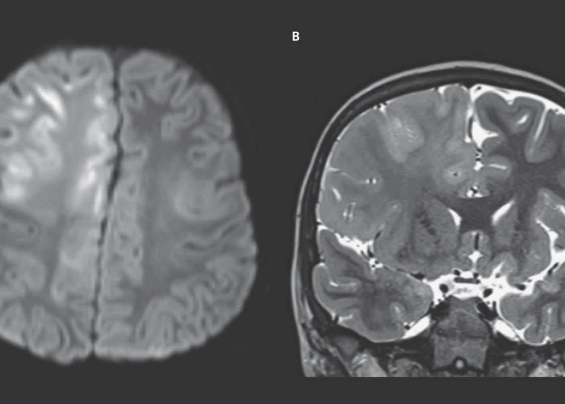 Measles Can Tear Your Brain Apart, and Scientists Are Showing the End Result