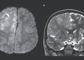 Measles Can Tear Your Brain Apart, and Scientists Are Showing the End Result