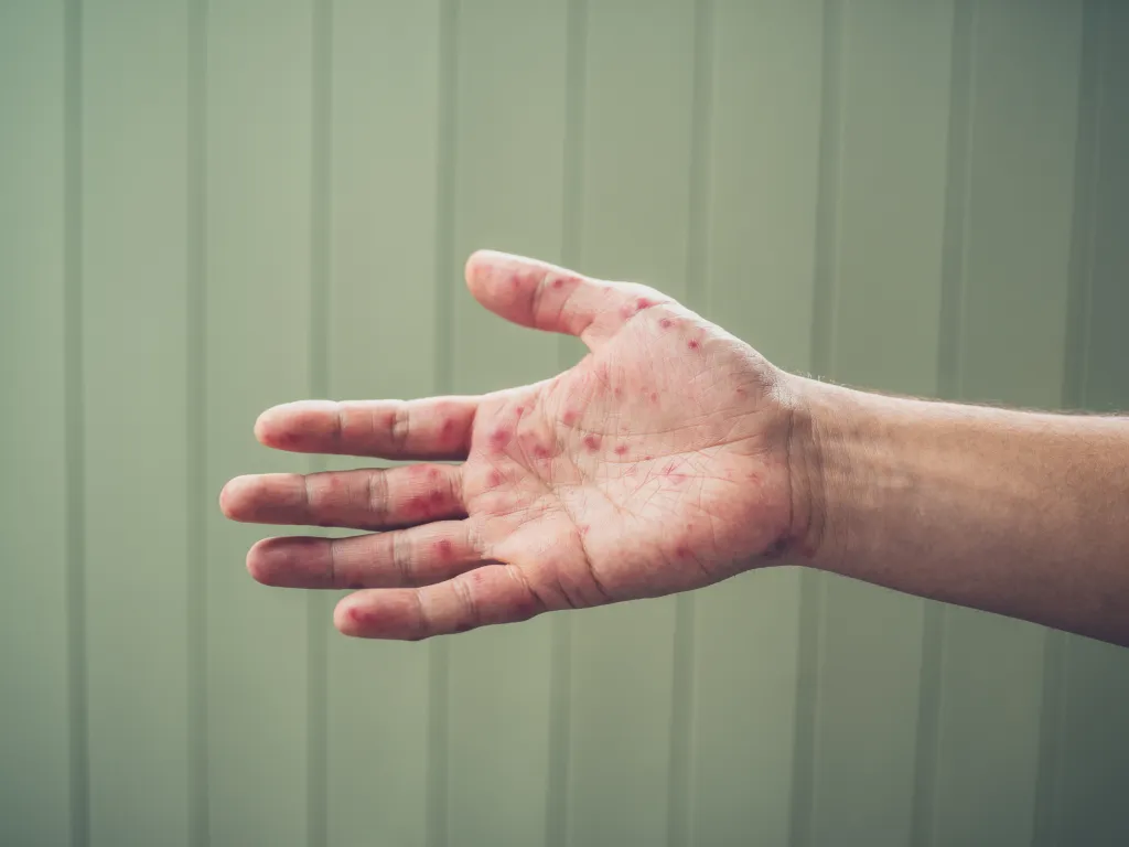 A young man's hand with a rash from hand, foot, and mouth disease.