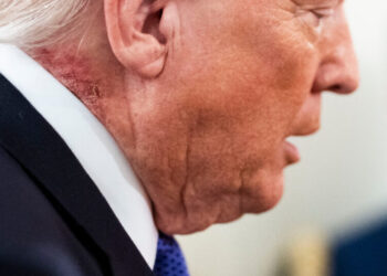 Latest Question on Trump’s Health: What Is That Neck Rash?