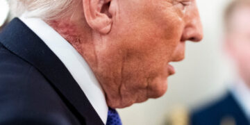 Latest Question on Trump’s Health: What Is That Neck Rash?