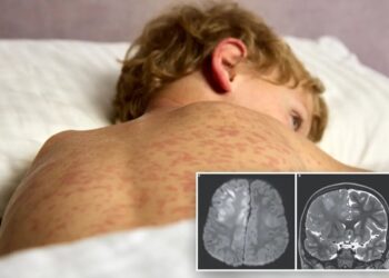 Boy, 7, dies of brain condition caused by world’s most contagious disease — years after he had it as a baby