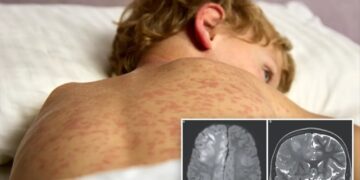 Boy, 7, dies of brain condition caused by world’s most contagious disease — years after he had it as a baby
