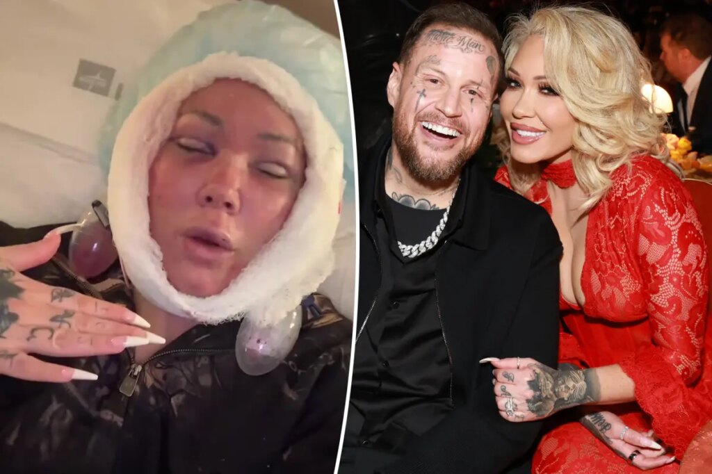 Jelly Roll’s 46-year-old wife, Bunnie Xo, unveils gruesome aftermath of facelift