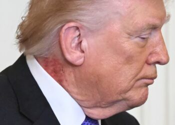 MAGA Melts Down Over 79-Year-Old Trump’s Bizarre New Ailment