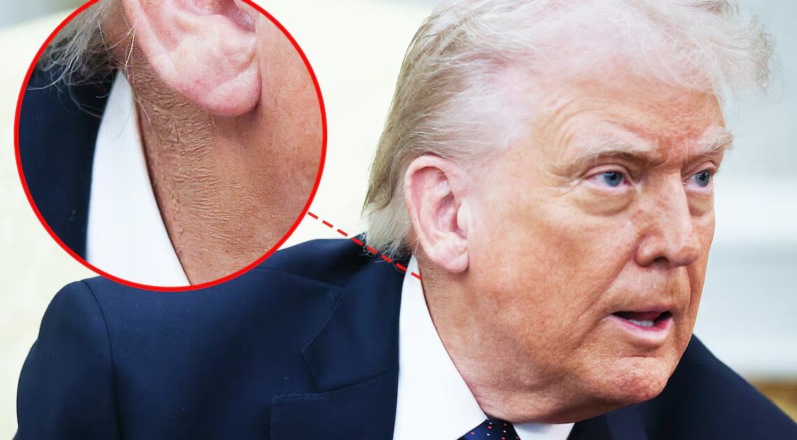 Trump, 79, Uses Favorite Fix to Battle New Health Problem