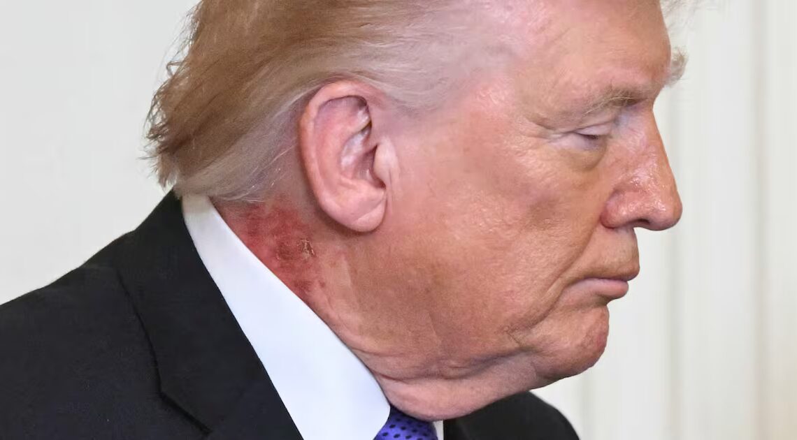 Doctor Says Trump’s Golf Habit May Be Reason for Mysterious Rash