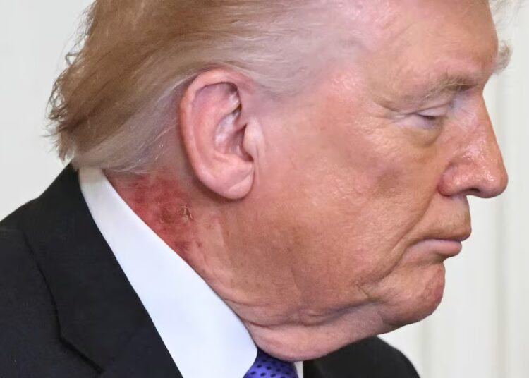 Doctor Says Trump’s Golf Habit May Be Reason for Mysterious Rash