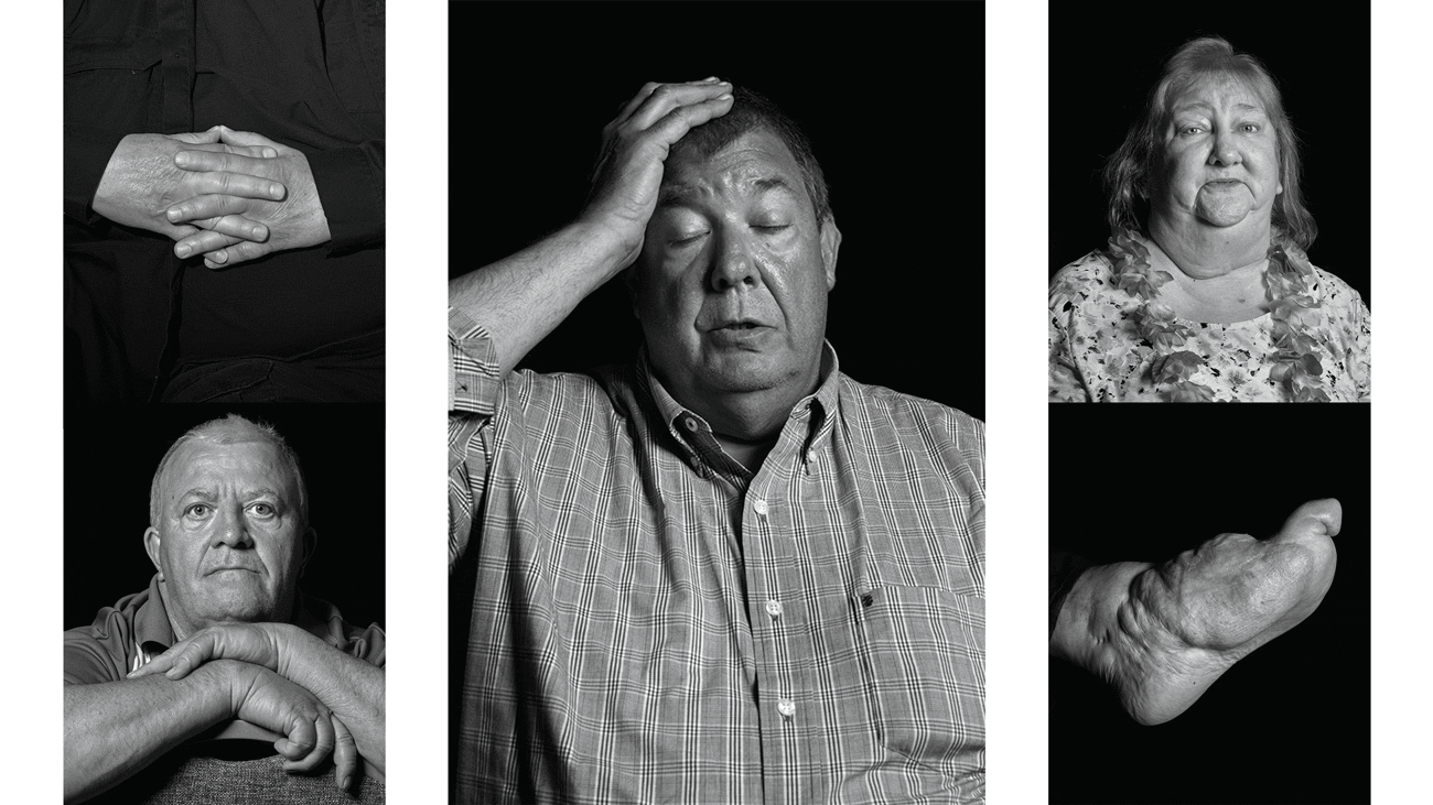 gif of multiple black-and-white photographs of lightning-strike survivors and scars