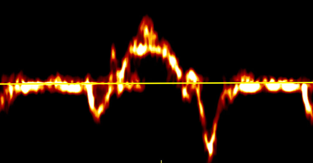 Women Who Undergo Menopause Before 40 Face Higher Heart Attack Risk