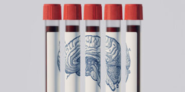 Could a Blood Test Predict if You’ll Get Alzheimer’s?