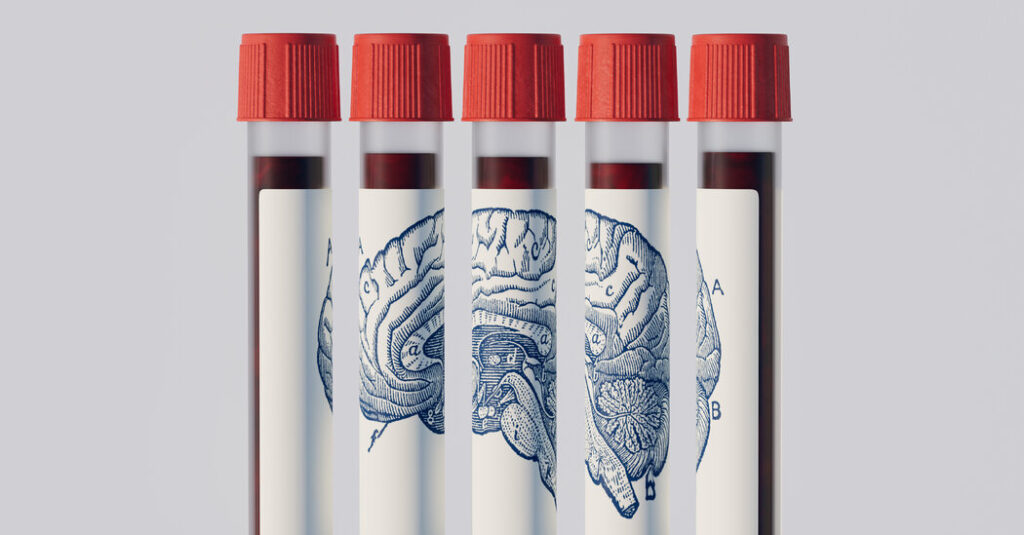 Could a Blood Test Predict if You’ll Get Alzheimer’s?