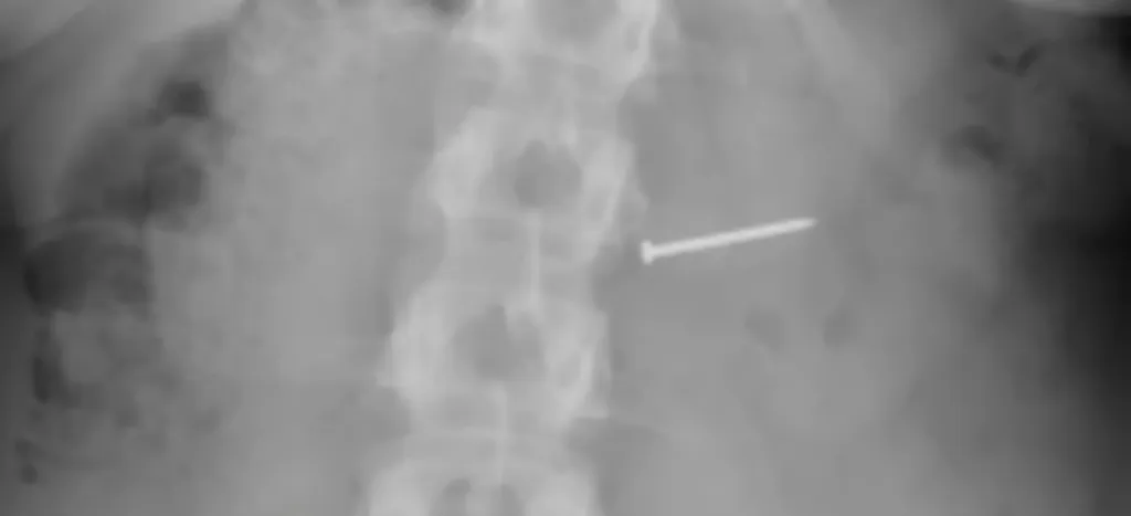 X-ray shows a metal nail lodged inside Brandy Buckley after she swallowed contaminated ice cream.