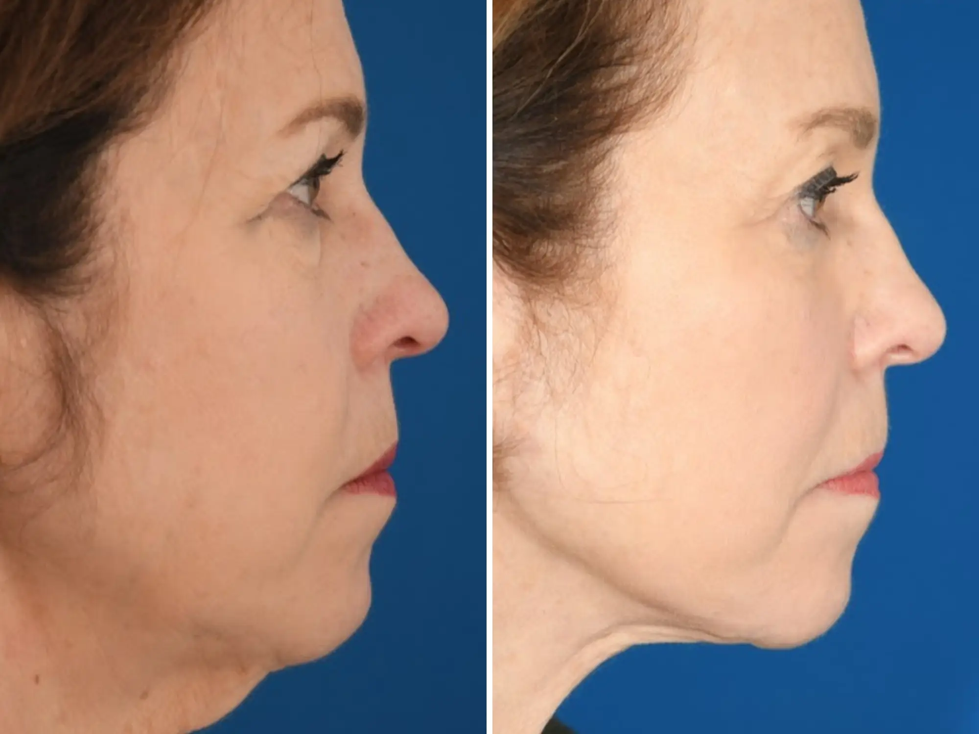 a woman's before and after of a facelift