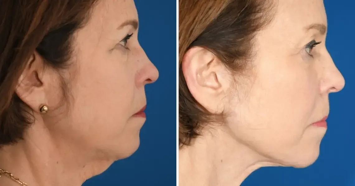 I’ve spent $33,000 on cosmetic procedures at 65. It’s been life-changing for my career and confidence.