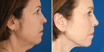 I’ve spent $33,000 on cosmetic procedures at 65. It’s been life-changing for my career and confidence.