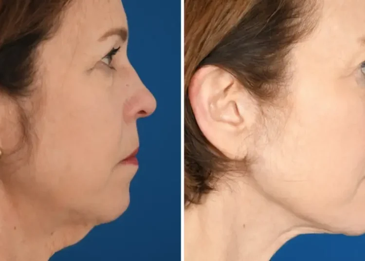 I’ve spent $33,000 on cosmetic procedures at 65. It’s been life-changing for my career and confidence.