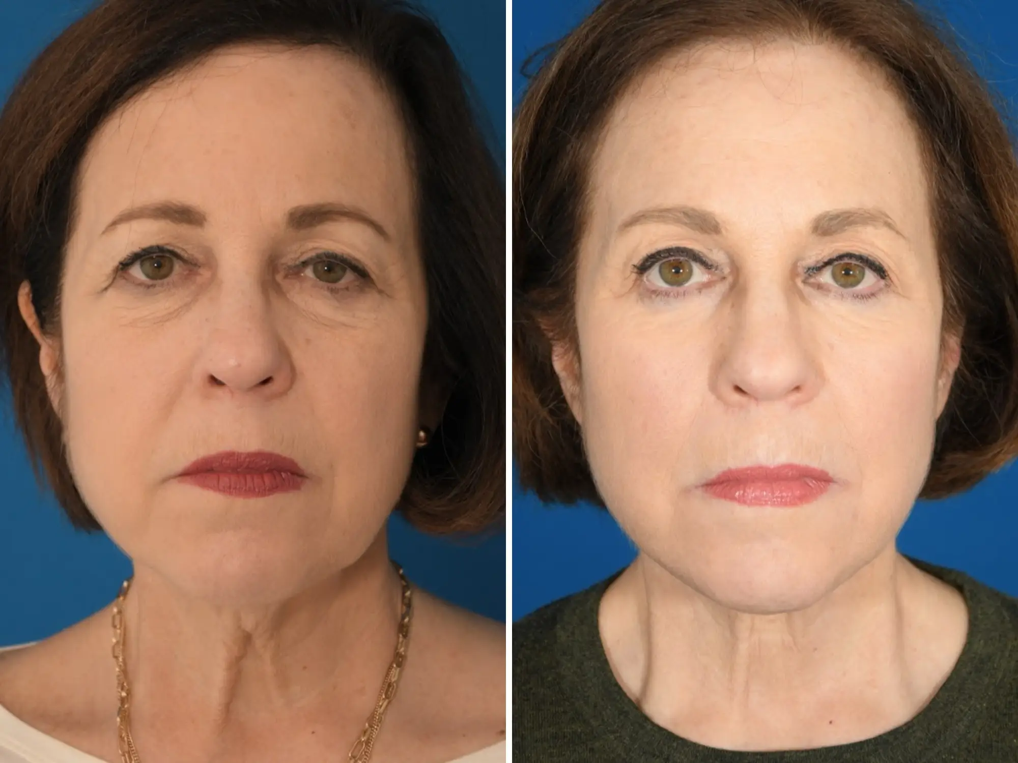 a woman's before and after of a facelift