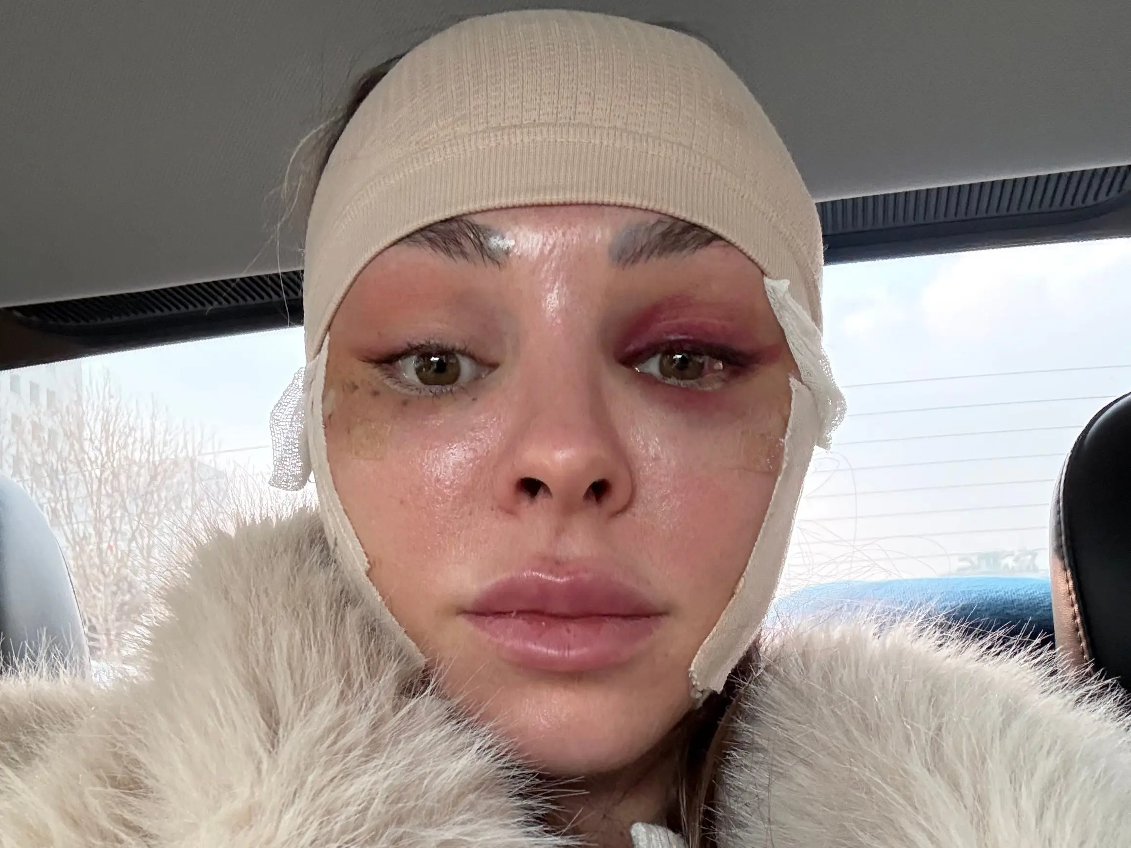 A woman in a car after having a facelift
