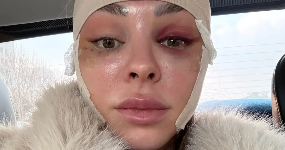 I traveled from the US to South Korea to get a facelift at 34. It boosted my confidence.