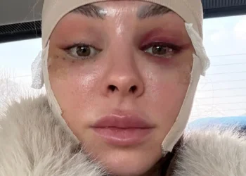 I traveled from the US to South Korea to get a facelift at 34. It boosted my confidence.