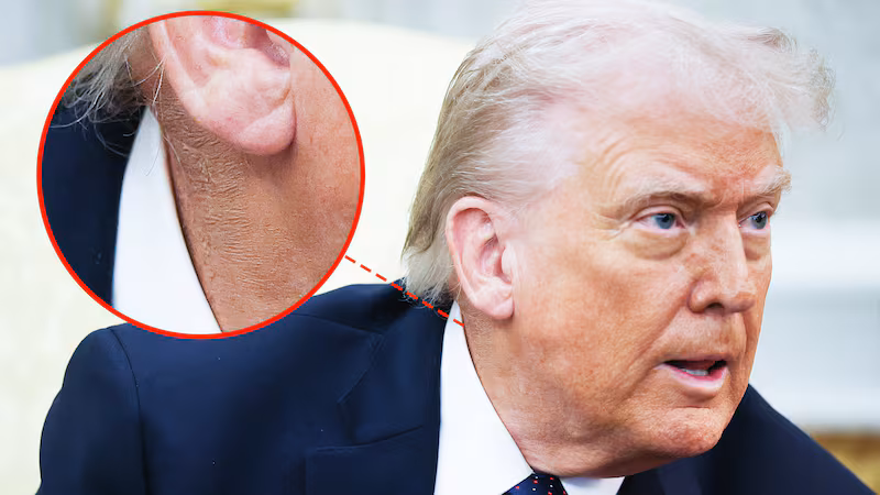 A circle highlighting makeup covering a rash on Trump's neck. President Donald Trump answers questions while meeting with German Chancellor Friedrich Merz in the Oval Office of the White House March 3, 2026 in Washington, DC.
