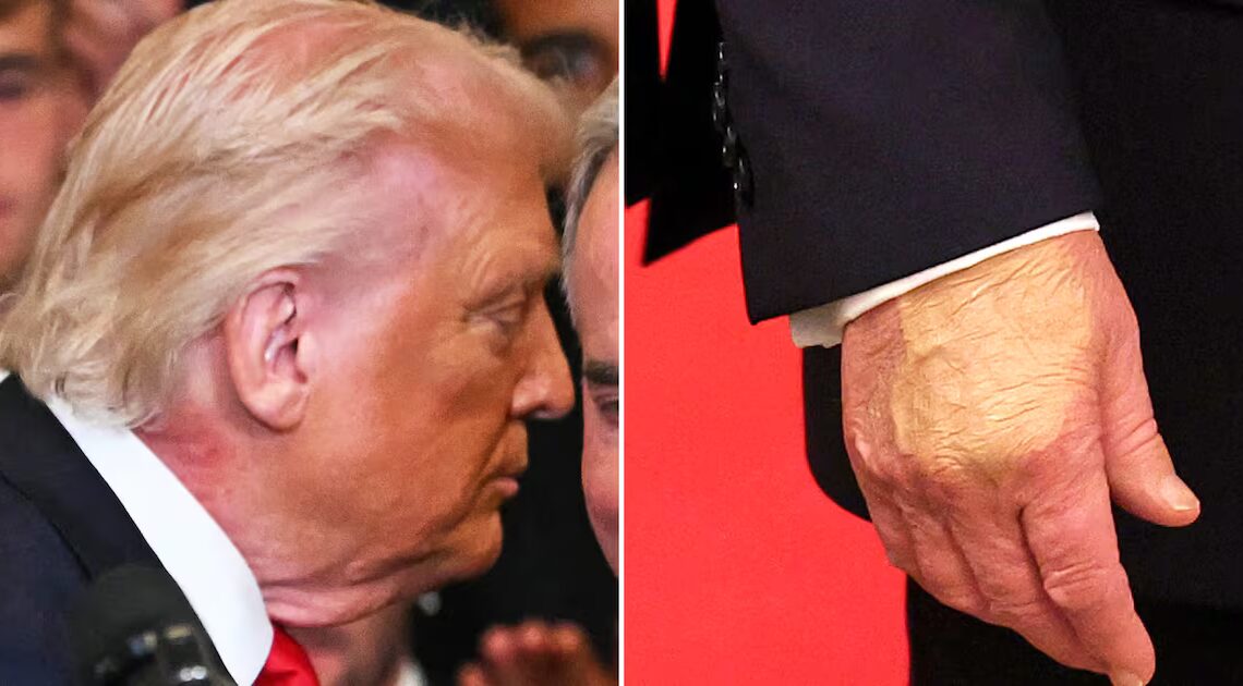 Trump, 79, Slathers Makeup on Bruised Hand But Can’t Hide Neck Rash