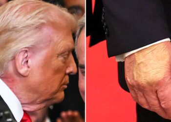 Trump, 79, Slathers Makeup on Bruised Hand But Can’t Hide Neck Rash