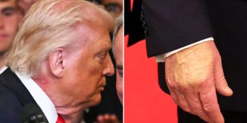 Trump, 79, Slathers Makeup on Bruised Hand But Can’t Hide Neck Rash