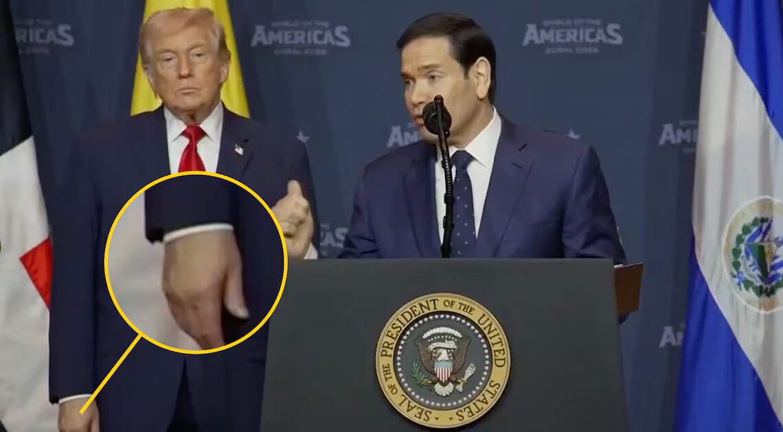 Trump, 79, Slathers Swollen Hand in Makeup For Suck-Up Summit