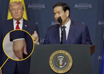 Trump, 79, Slathers Swollen Hand in Makeup For Suck-Up Summit