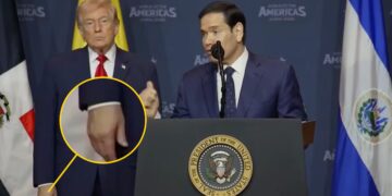 Trump, 79, Slathers Swollen Hand in Makeup For Suck-Up Summit