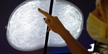 The surprising way breast cancer screenings could reveal heart disease