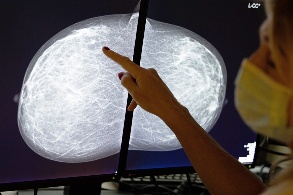 The surprising way breast cancer screenings could reveal heart disease