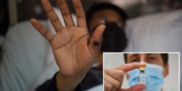 First known case of severe mpox virus strain detected in NYC