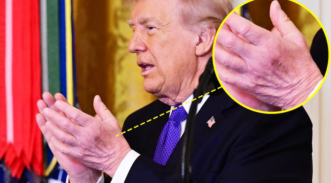 Trump’s Neck Rash Distracts From New Bruise on ‘Good’ Hand