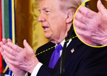 Trump’s Neck Rash Distracts From New Bruise on ‘Good’ Hand