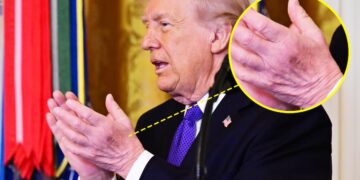 Trump’s Neck Rash Distracts From New Bruise on ‘Good’ Hand