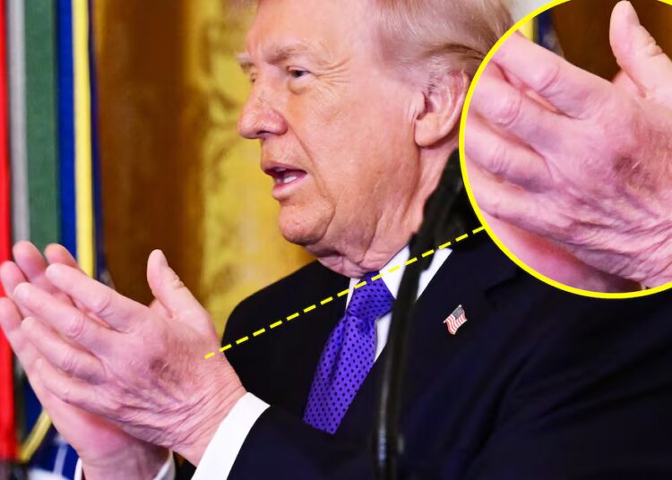 Trump’s Neck Rash Distracts From New Bruise on ‘Good’ Hand