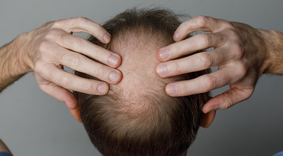 Scientists Are Growing Hair Follicles in a Lab, and It Might Fix Your Bald Head