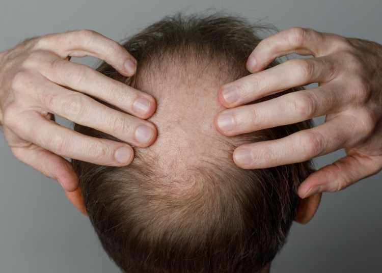 Scientists Are Growing Hair Follicles in a Lab, and It Might Fix Your Bald Head